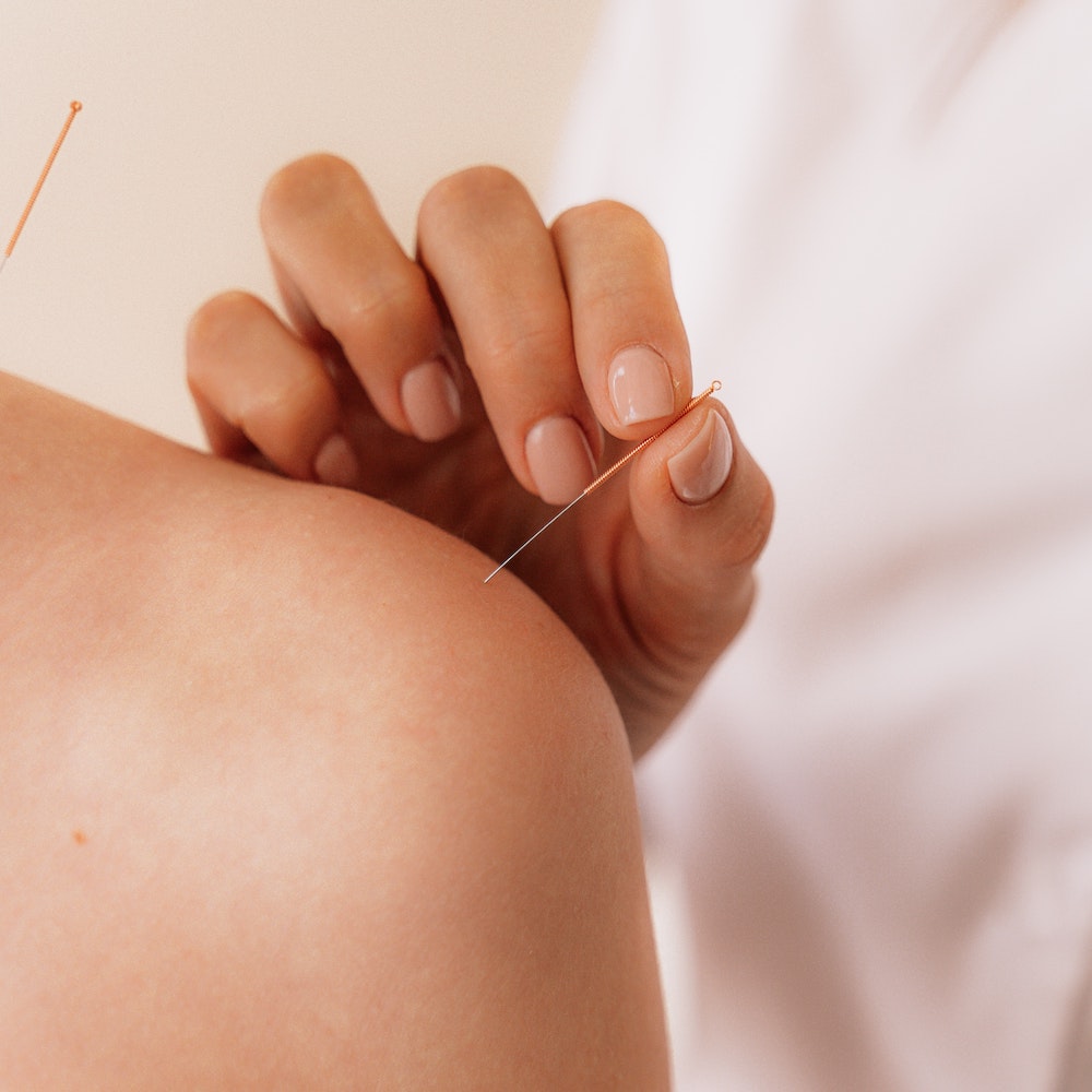 Dry Needling vs Acupuncture