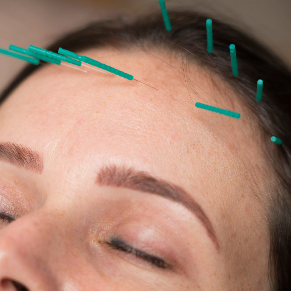 Acupuntura Estética Holística (Curso)